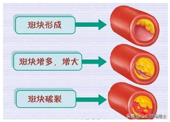 消除斑块的食物食谱,消除斑块最好的水果