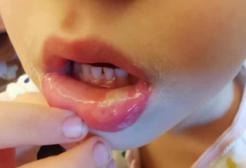 小孩口腔黏膜白斑,婴儿口腔颊黏膜白斑怎样治疗