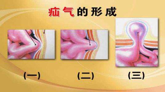 老年腹股沟疝气保守治疗有效方法,疝气中医治疗怎么锻炼有助于恢复