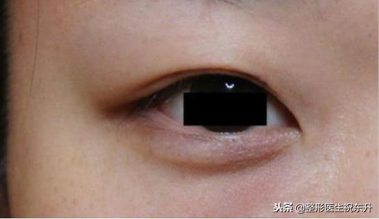 割双眼皮后怎样可以尽快完全恢复,割双眼皮的危害老了以后会怎样
