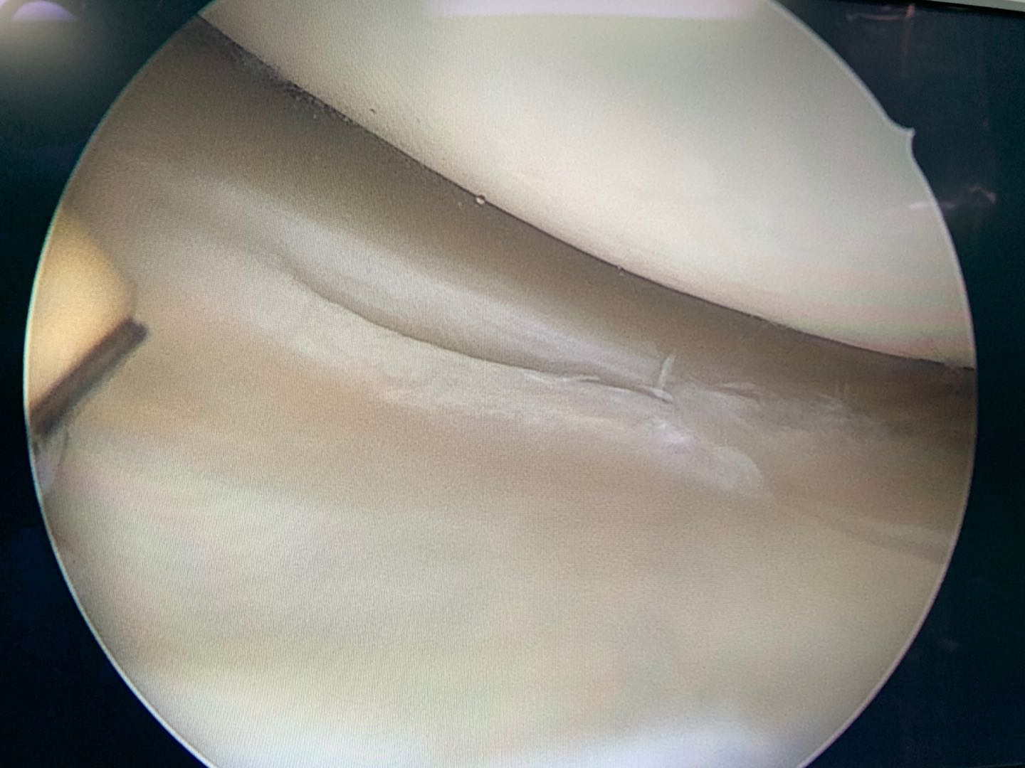 半月板撕裂多长时间能完全恢复nba,半月板受伤有没有完全恢复的可能