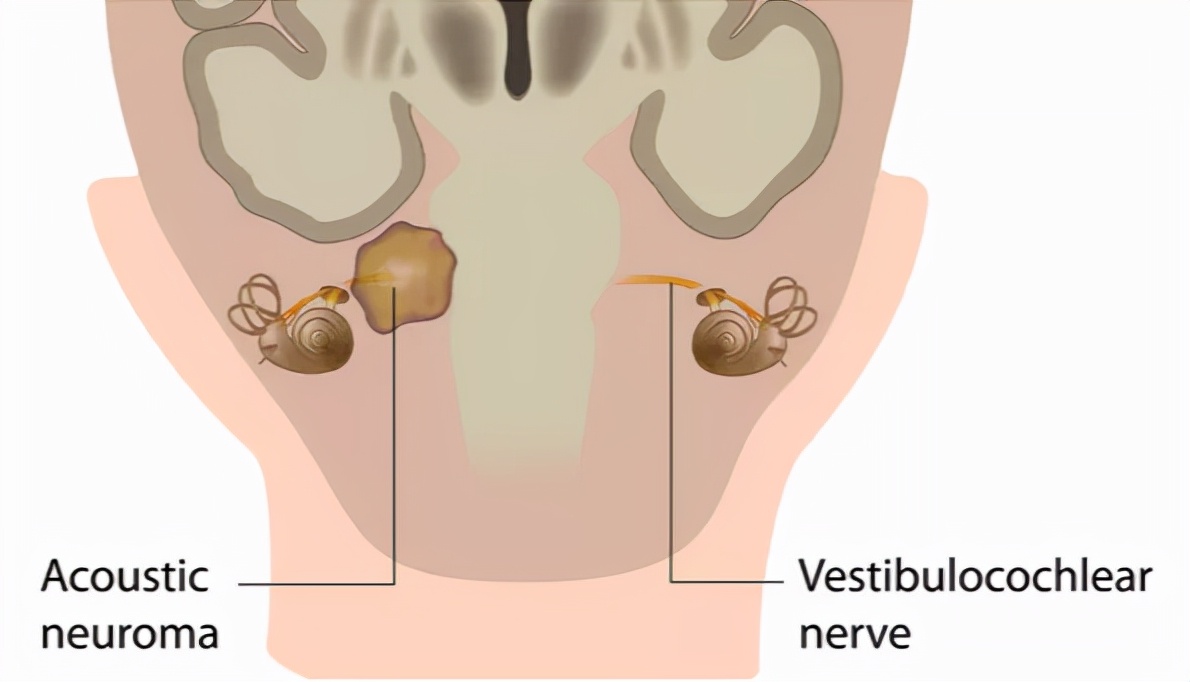 听神经瘤突聋能恢复吗,听神经瘤耳聋了怎么办