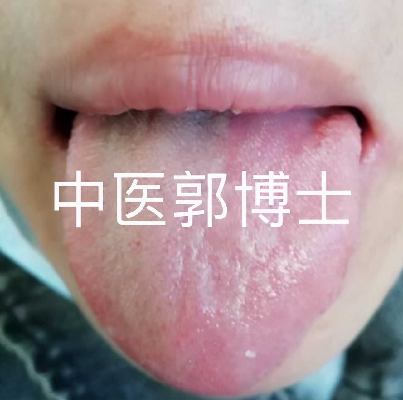 脾大引起血小板低中药调理,脾切除后血小板高中医辨证