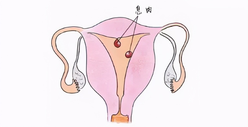 子宫内膜息肉诊刮多久可以怀孕,子宫内膜息肉手术后还是没怀孕