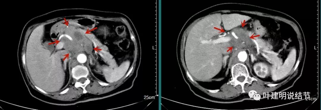 特瑞普利单抗食管癌成功案例,特瑞普利单抗治疗食管癌效果好吗