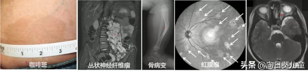 1型神经纤维瘤最佳治疗方案,神经纤维瘤最轻的是哪型