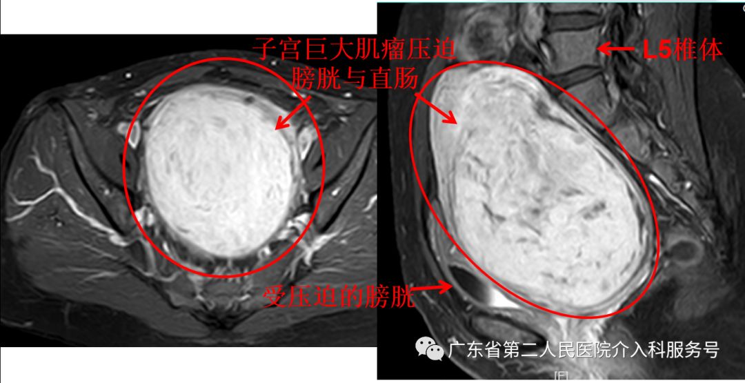 子宫肌瘤引起“大姨妈”排山倒海，淋沥不净……针眼妙方解除烦恼