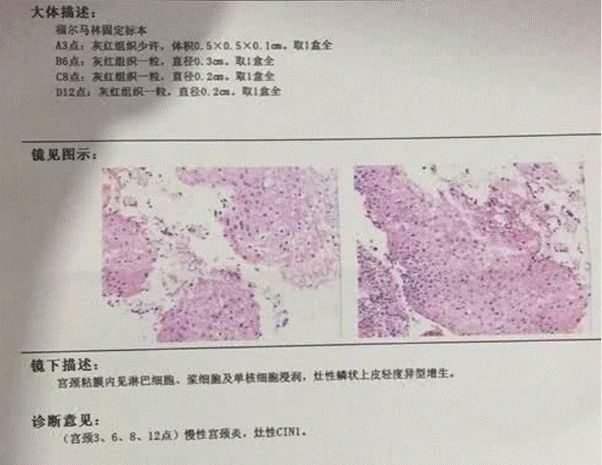 和hpv抗争十四年,我的hpv4价疫苗心得