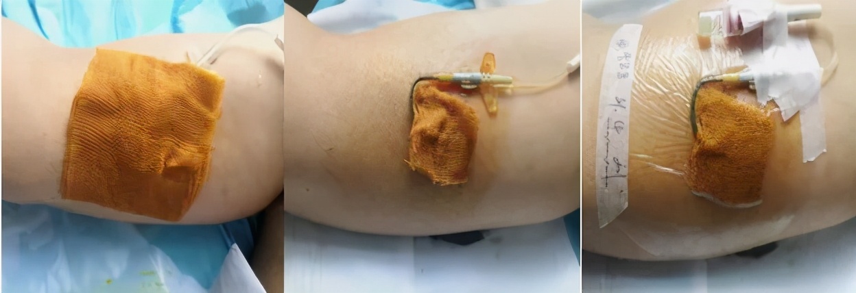 碘伏治疗伤口吗,碘伏治疗伤口发炎吗