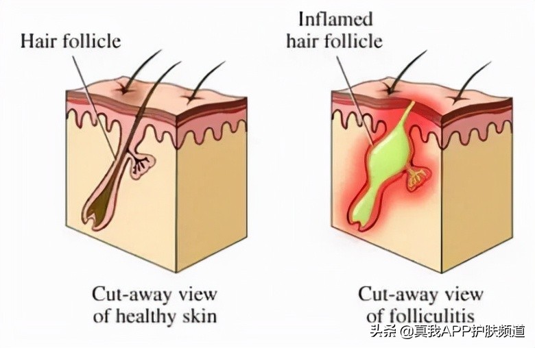 男士后背毛孔粗大堵塞怎么办,后背毛孔粗大有痘痘怎么解决