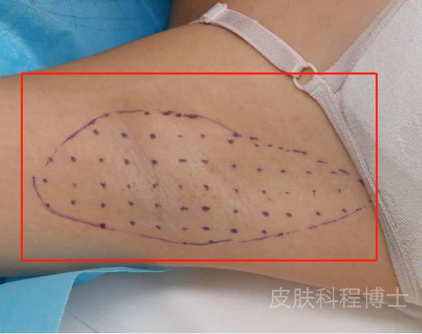 10岁女孩身上狐臭怎么治,十二岁女孩狐臭用什么药