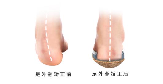 你的足弓正常吗？只需简单一招，轻松解决足弓问题