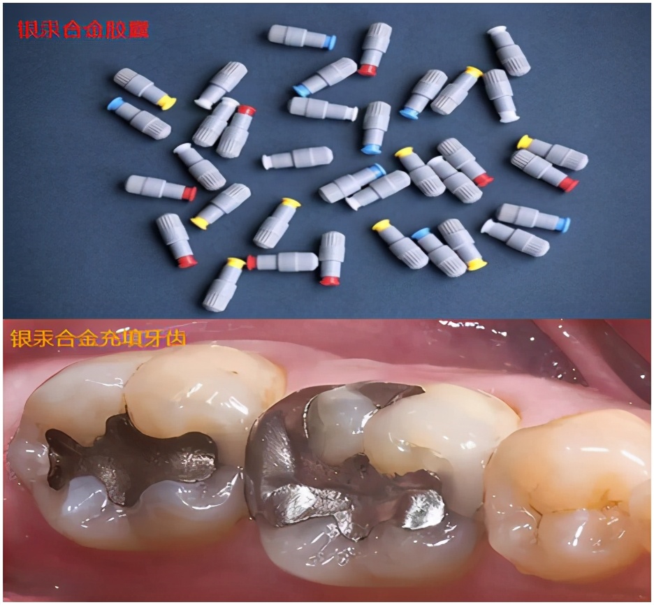 600块钱一颗牙怎么样,600块一颗牙贵吗