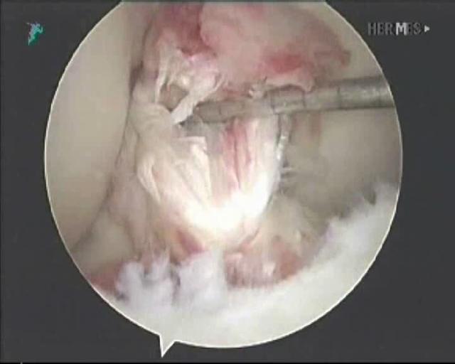 膝关节前叉重建是缝合吗,膝关节前叉韧带重建半月板修复