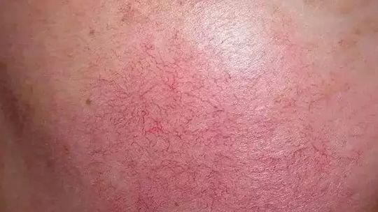 红血丝皮肤护理方案话术,红血丝肌肤的护理方法