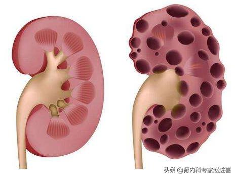 多囊肾有结石应该注意什么,多囊肾病人的饮食要注意什么
