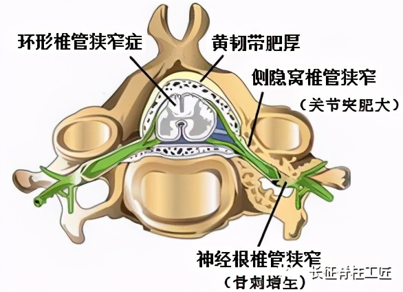 老年人腰椎管狭窄可以微创手术吗,老年人腰椎管狭窄瘫痪