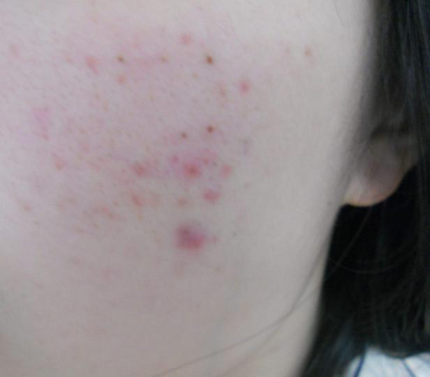 痘痘肌化妆教程化妆品,痘痘肌化妆需要哪些化妆品