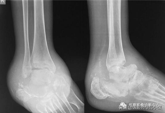 神经性脊椎炎,神经性风湿病