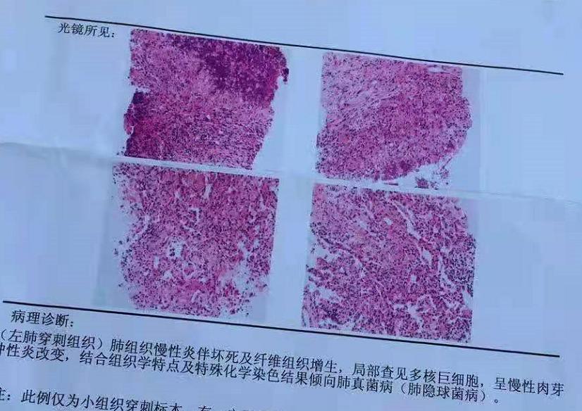 9mm肺结节实性结节良性几率多大,良性肺结节生长速度