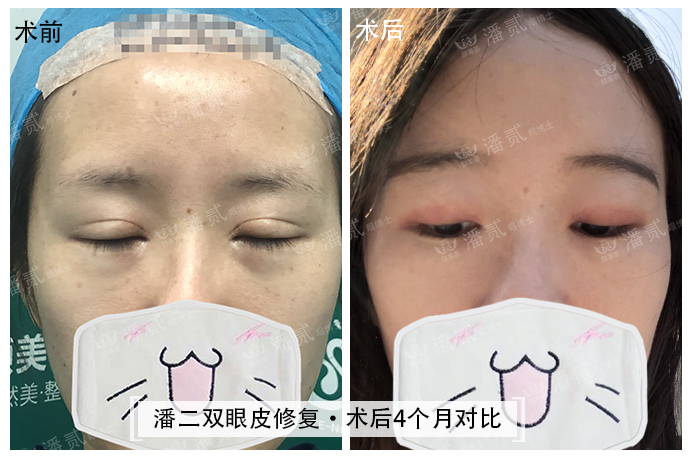 眼角下垂做双眼皮手术可以改变吗,后悔做双眼皮