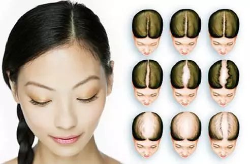 远离脱发这4个问题你需要知道,脱发问题越来越常见了