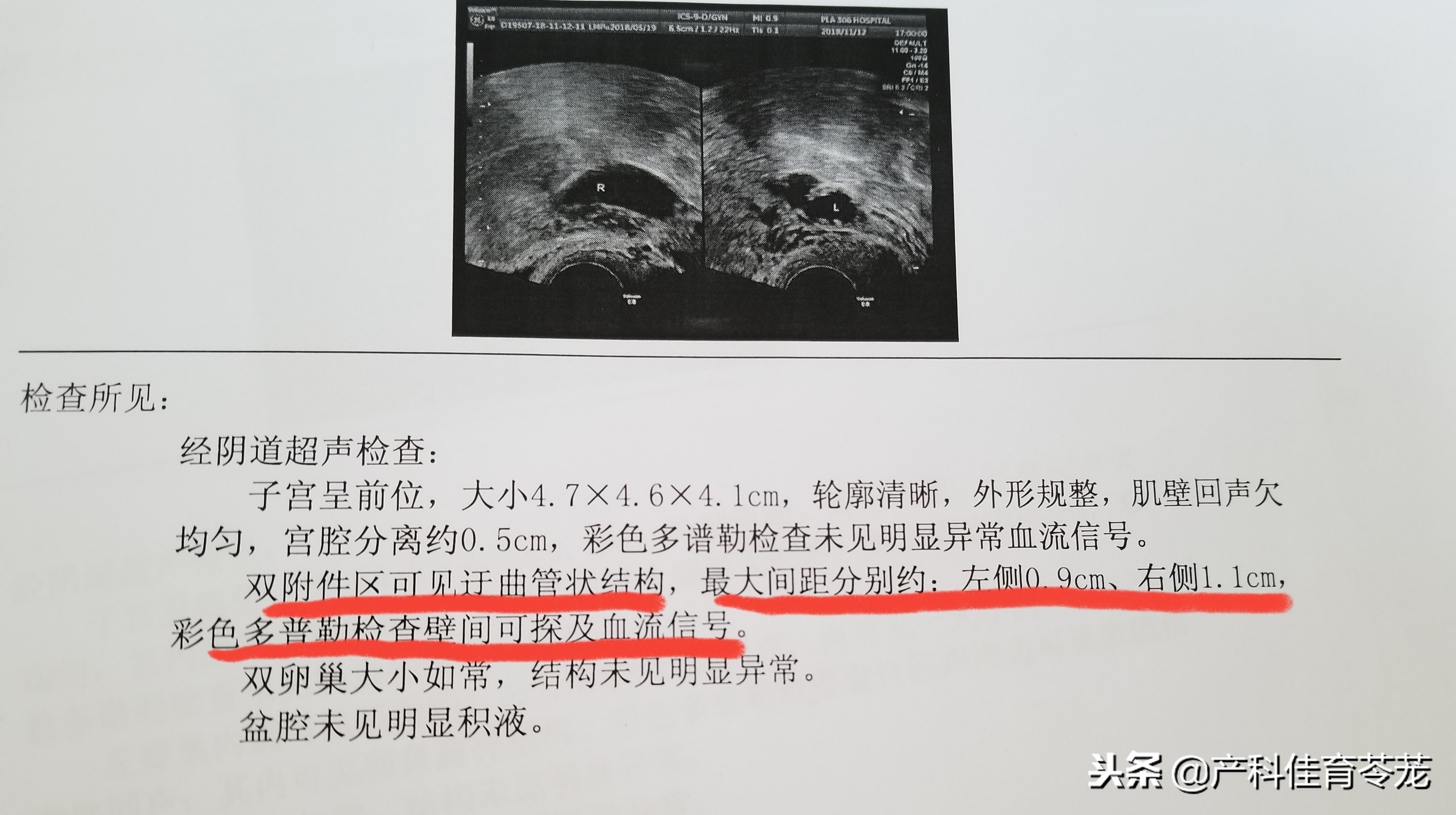 b超提示输卵管有积液,b超输卵管造影后为什么盆腔积水