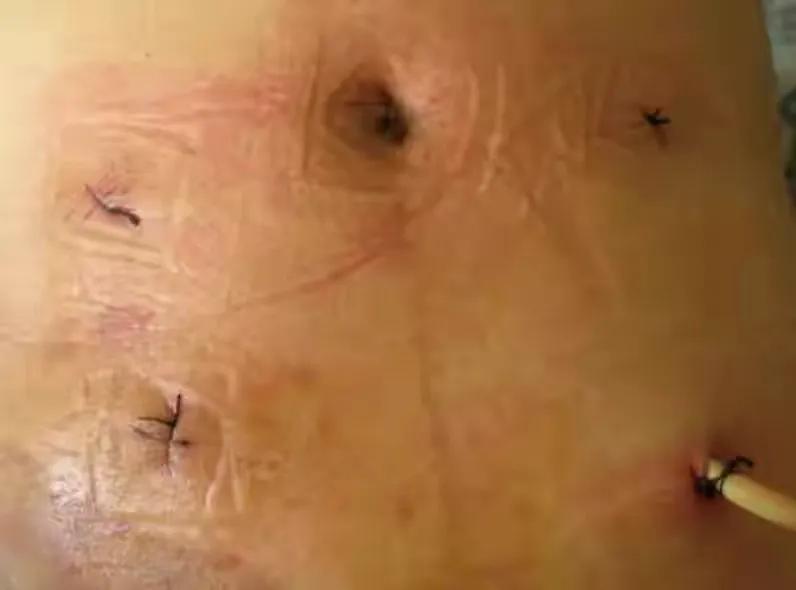 肛肠科新技术新项目,实用肛肠病系列疗法新技术