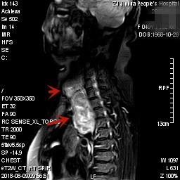甲状腺肿瘤超大,胸骨后甲状腺肿病情是否很严重