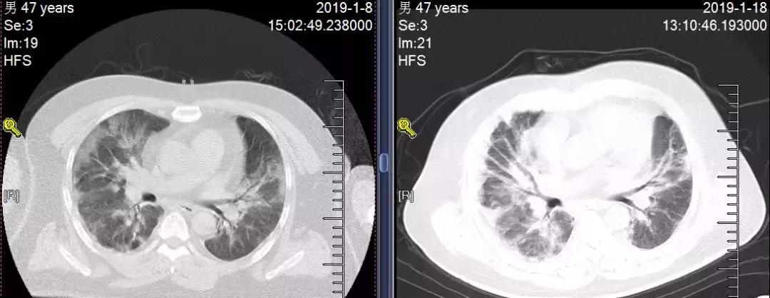 流感重症肺炎患者好转后皮疹、口腔白膜，流感病毒感染如何用激素