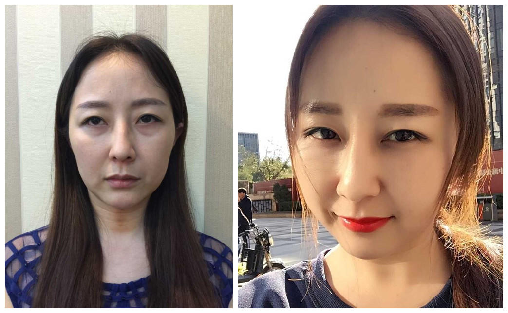 提升脸部下垂做什么项目好,皮肤下垂怎么办可以做面部提升吗