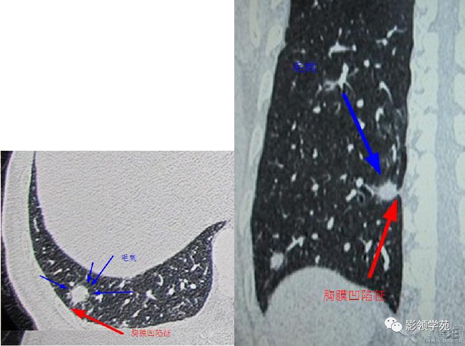 肺肉芽肿影像学表现ppt,肺韦格纳肉芽肿影像学表现