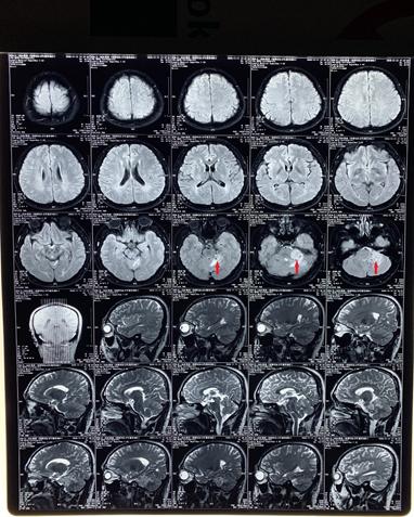 头晕耳鸣听力下降,头晕脑胀听力下降怎么回事