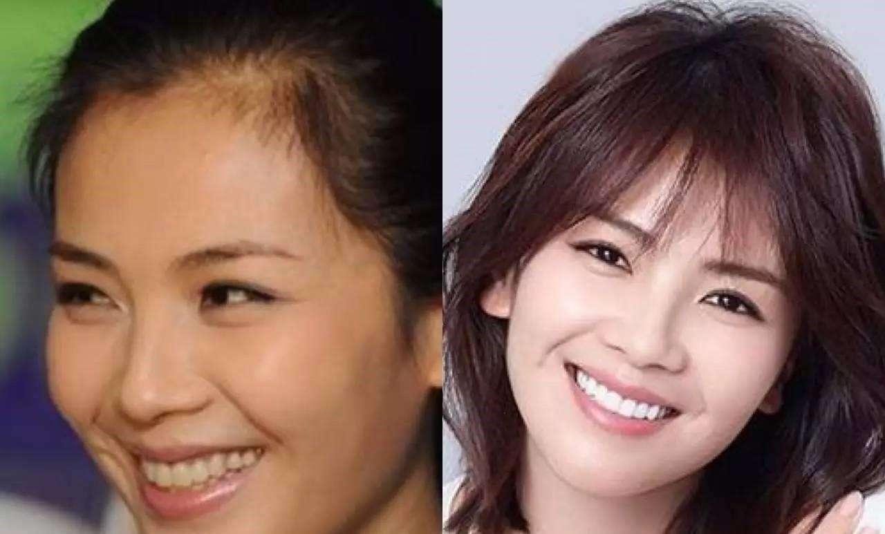 刘涛全瓷牙经验之谈,为什么刘涛说不要轻易做全瓷牙