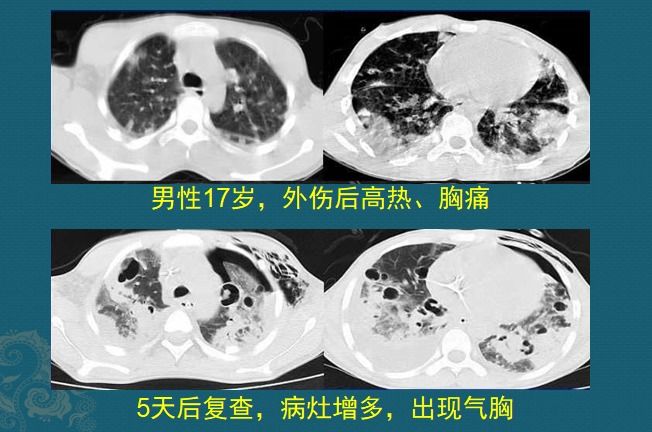 化脓性细菌感染用什么抗生素,化脓性细菌感染有痰用什么抗生素