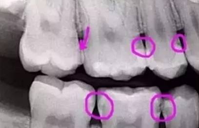 看牙为什么要拍照片,看牙拍片辐射大吗