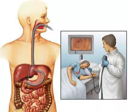 胃镜检查不只是个简单的检查,胃镜检查没你想象的那么可怕