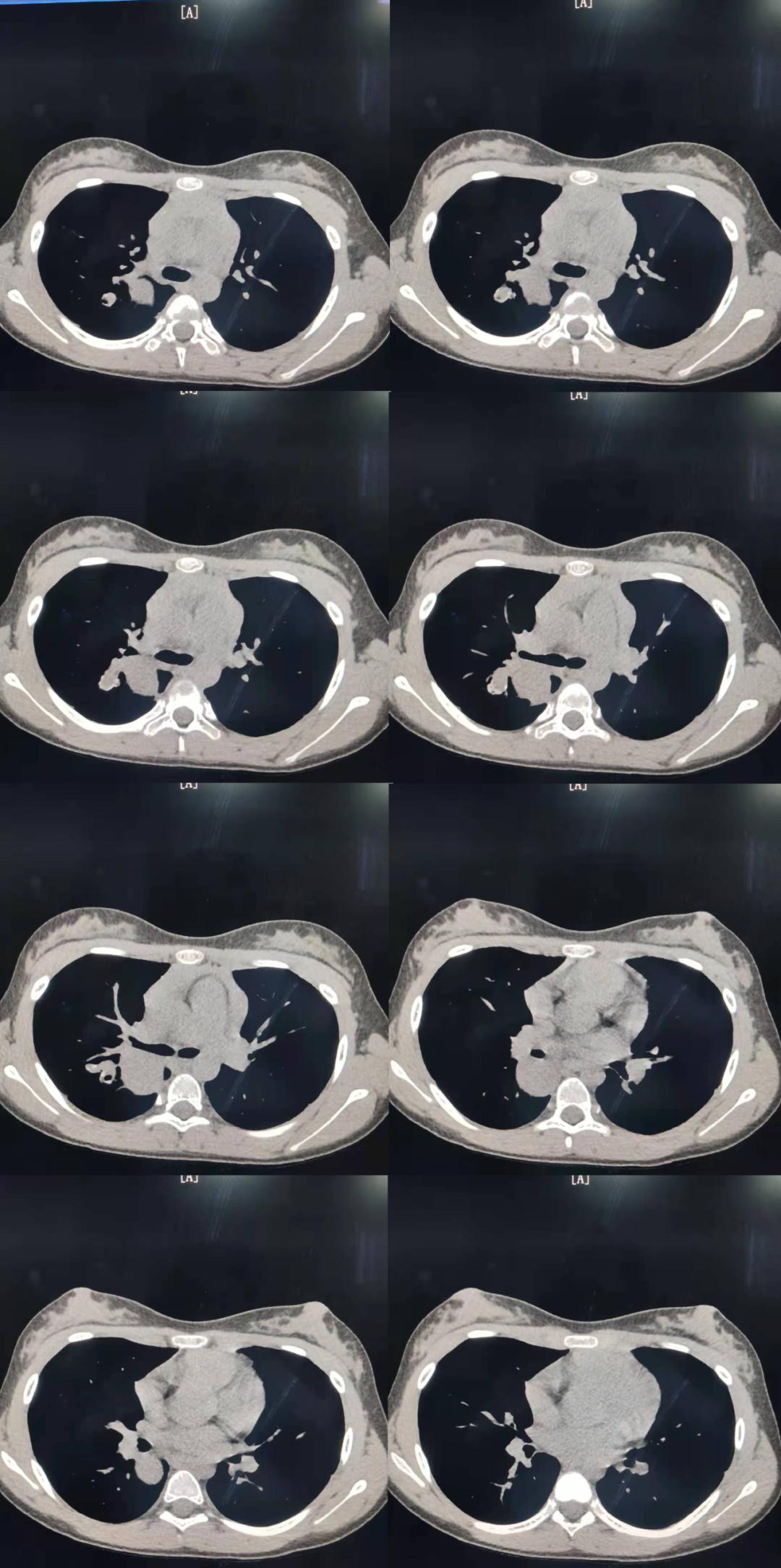 肺内见多发小囊状无纹理透光影,肺内肿块并厚壁空洞