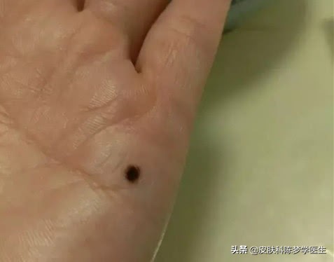 脸上长的痣如果癌变会怎样,最近身上脸上长了很多痣怎么回事