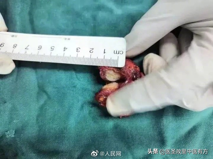 甲状腺结节有可能瞬间变成癌吗,甲状腺结节两年后不见了