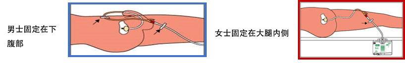 导尿管的护理及注意事项,双腔导尿管和三腔导尿管护理