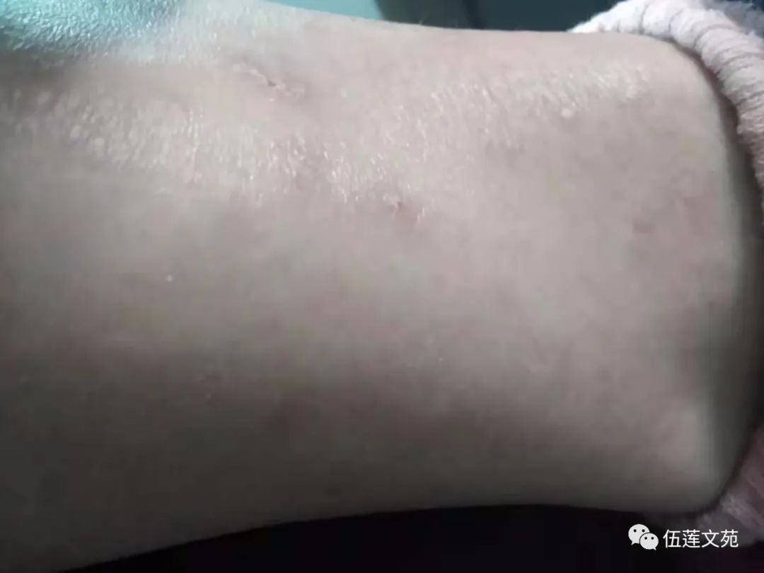 床上螨虫太多身上发痒怎么办,盖被子身上发痒怎么办