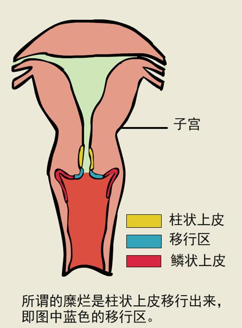 “馨妇产，爱无限”妇产讲堂第五十三期——揭秘“宫颈糜烂”