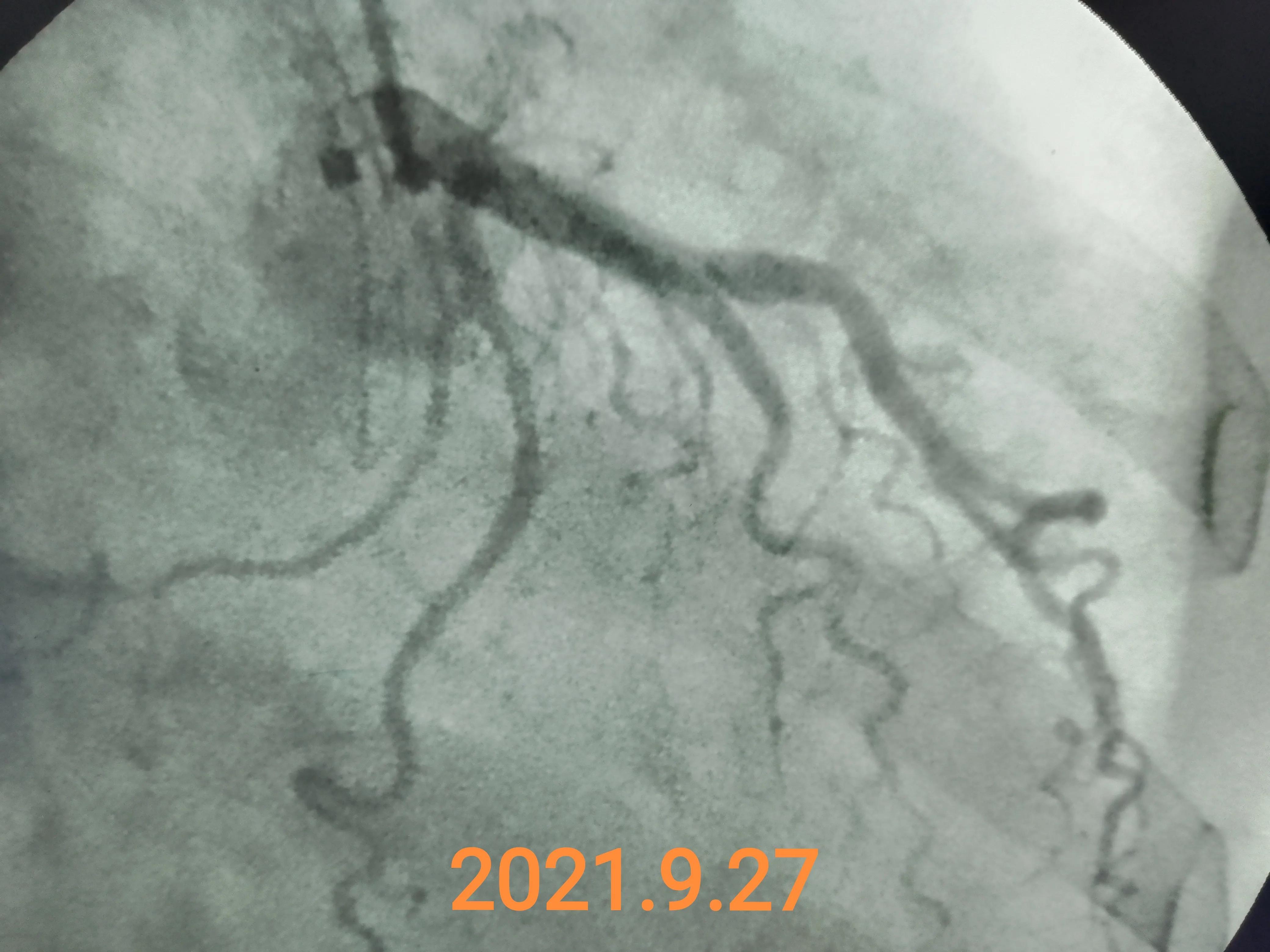 心血管病人吃伟哥,心血管病人可以用伟哥吗