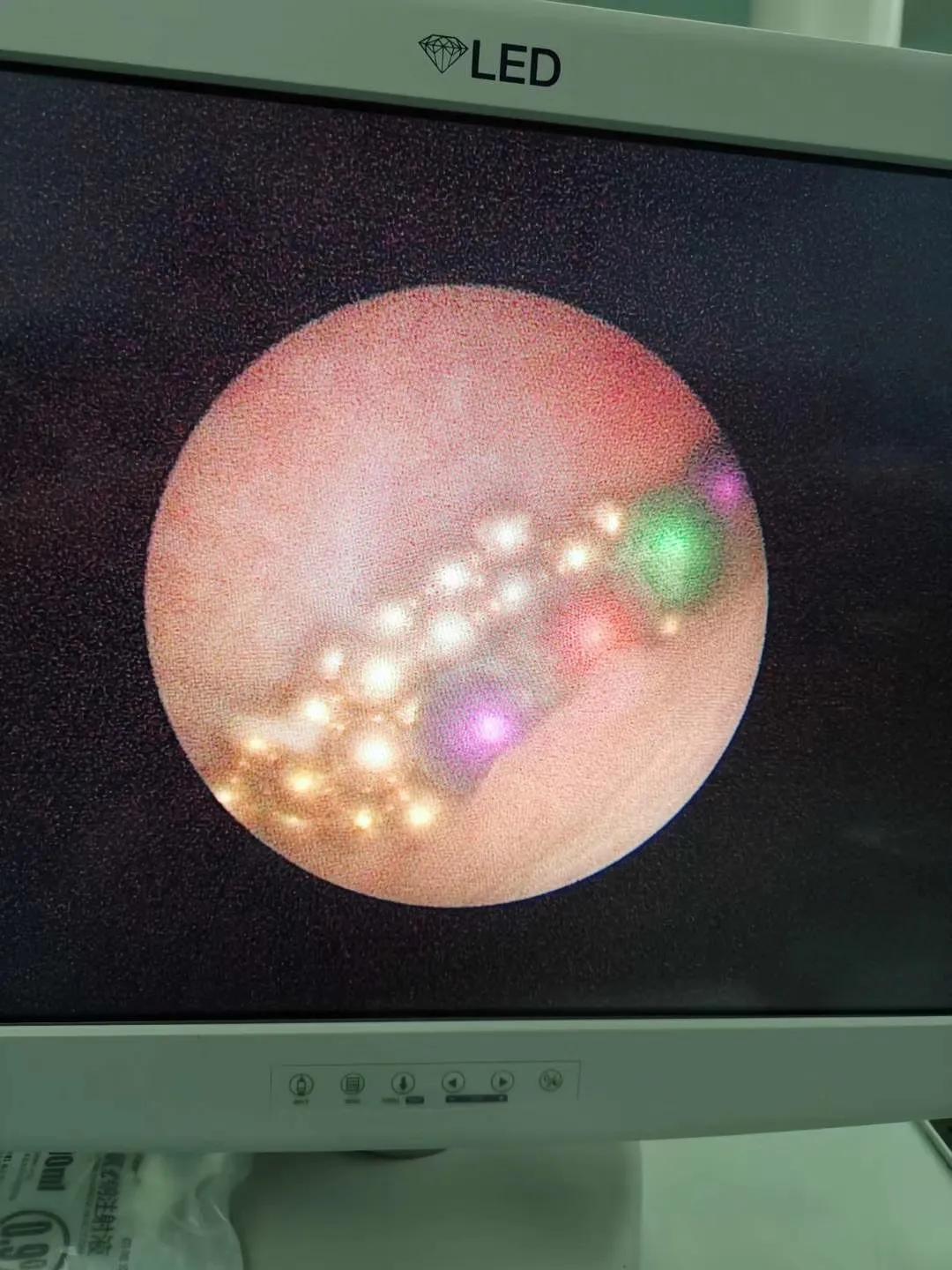 四岁小男孩往小丁丁里塞弹珠？那些年孩子塞进去的东西远不止这个