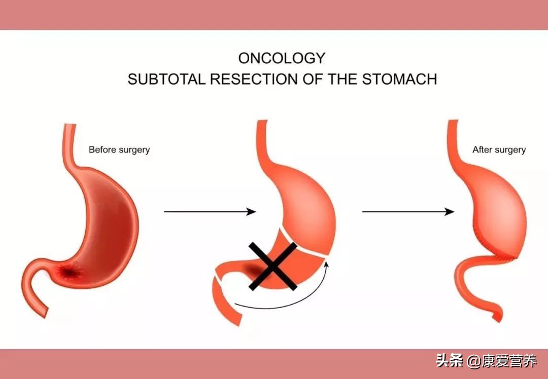 胃癌术后五大并发症区别,早期胃癌术后一年饮食哪些不能吃