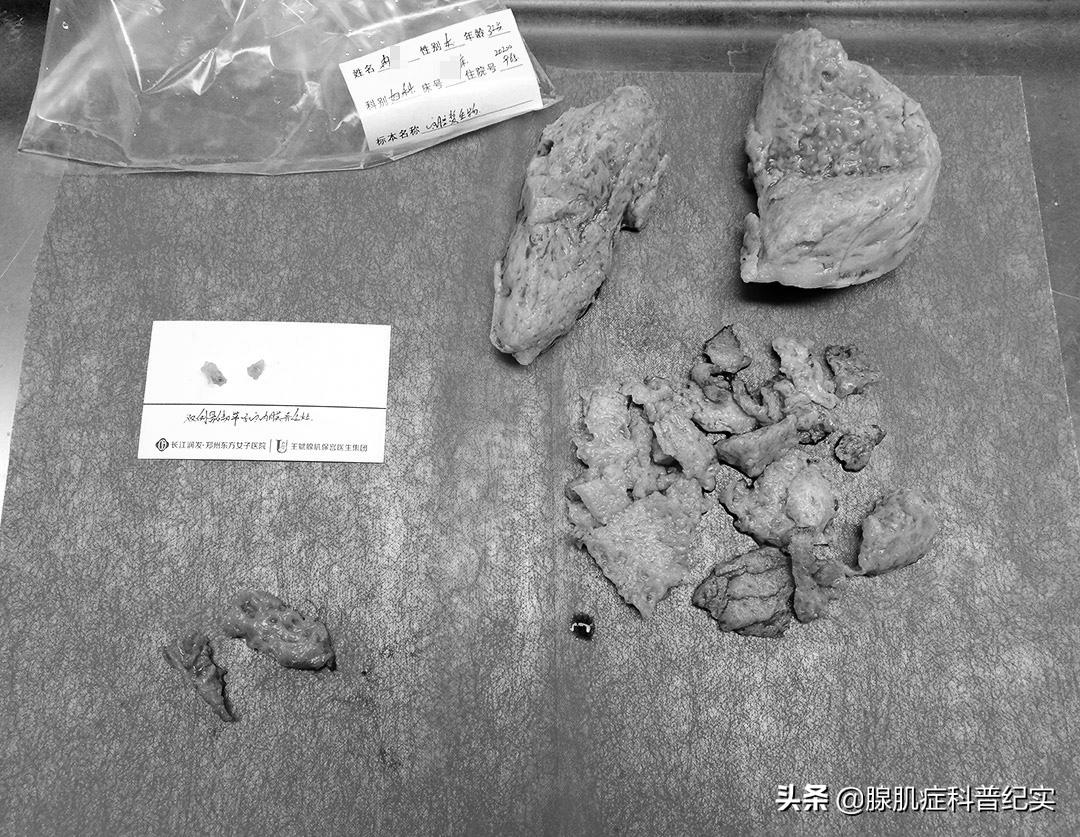 腺肌症诊刮后一直出血,腺肌症自救