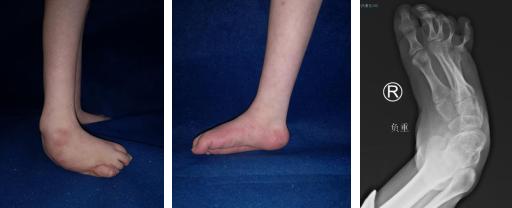 先天性马蹄足患者,先天性马蹄足后期会无法行走吗