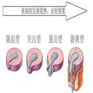 腰突各种治疗方法的认识不再盲目治疗