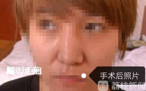 女子整形鼻子歪了失败,鼻子变歪的女人